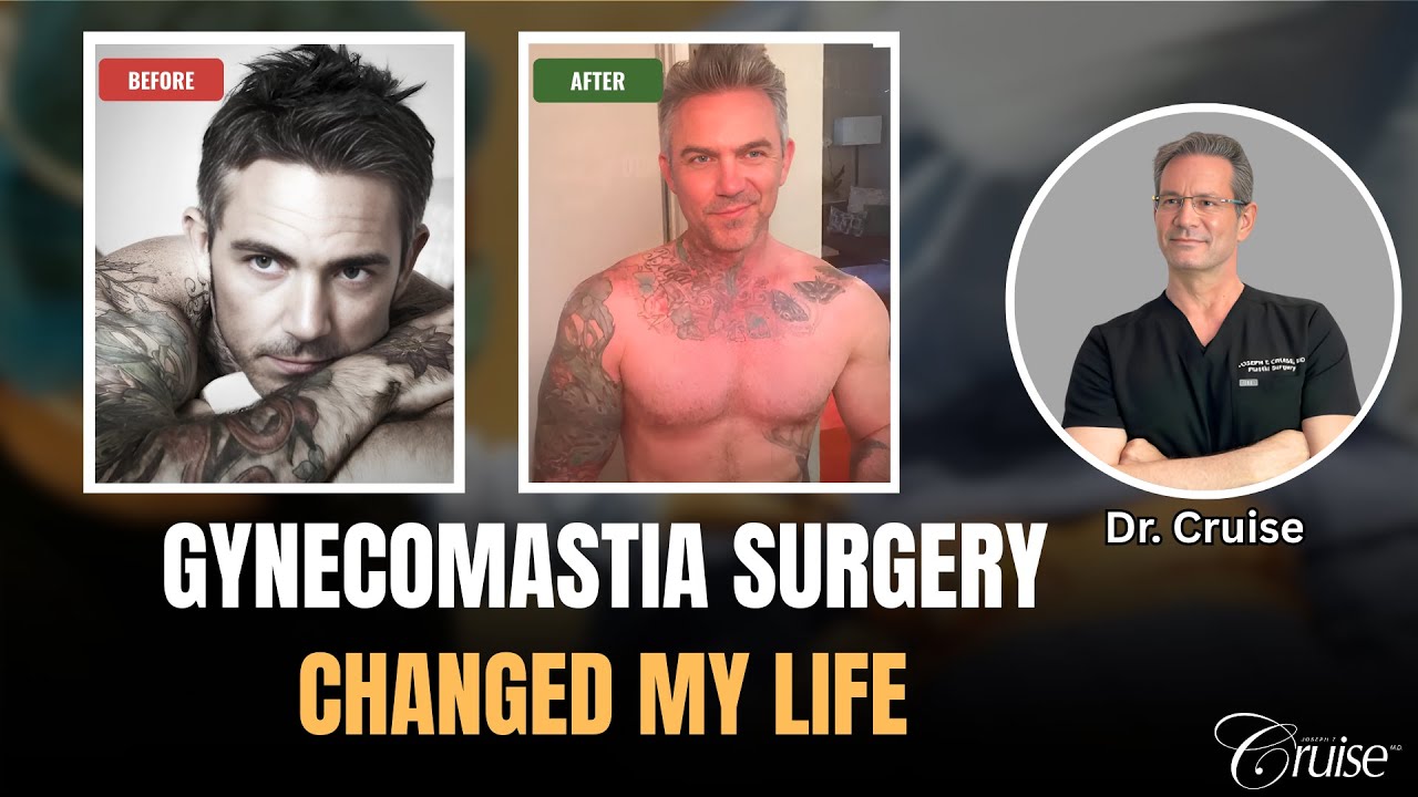 Gynecomastia surgery before and after transformation.