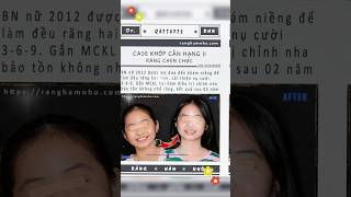 Case khớp cắn hạng II răng chen chúc