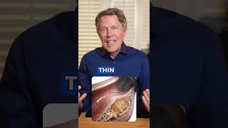 Soft Plaque vs Hard Plaque: Why the Difference Matters
