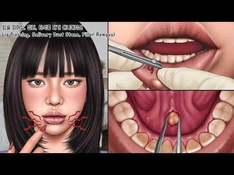 ASMR 입술 피어싱 조심해야하는 이유! 입술에 파묻힌 피어싱 제거 | 필러 압출, 타석증 | Piercing, Salivary Duct Stone, Filler Removal