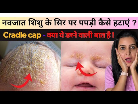 नवजात शिशु के सिर पर पपड़ी कैसे हटाएं - Cradle cap - क्या ये डरने वाली बात है