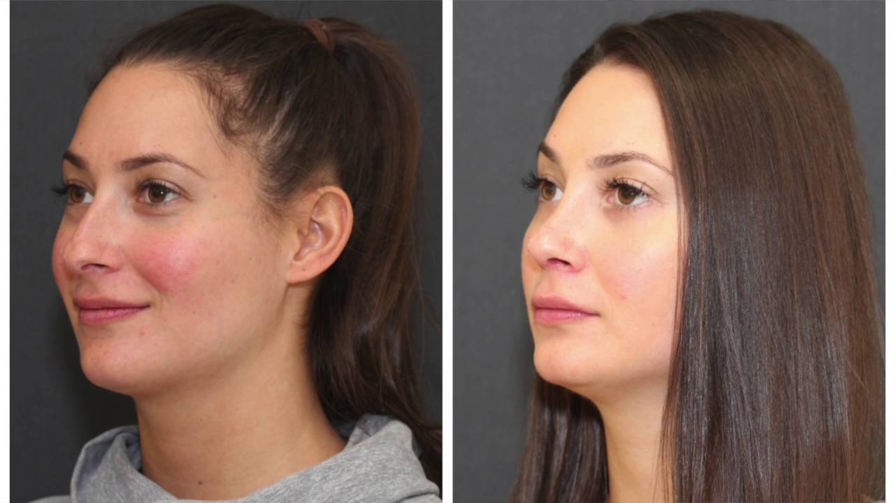 Before and after facial transformation images.