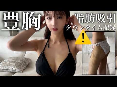 【激闘】豊胸・脂肪吸引ダウンタイムレポ。