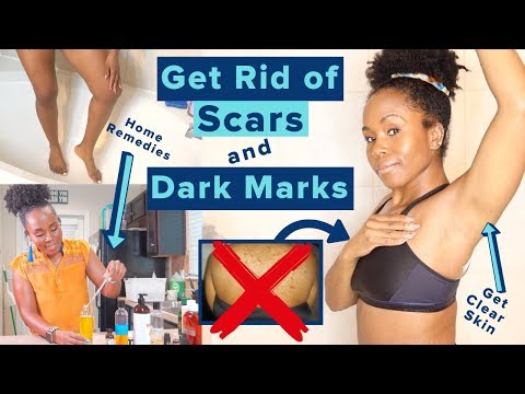 Get Rid of Hyperpigmentation, Scars, Dark Spots & Boil Scars on Your Body FAST | *Highly Requested*