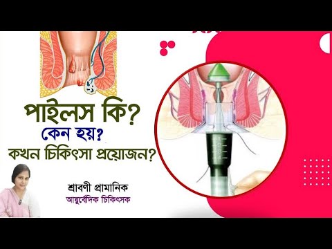 পাইলস রোগের লক্ষণ কি? বিনা অপারেশনে পাইলস বা অর্শ থেকে মুক্তির উপায় জেনে নিন