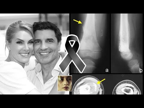 'MORRE APRESENTADORA, ESTAVA COM CANCER'| ANA HICKMANN APOS NOIVADO COM EDU GUEDES