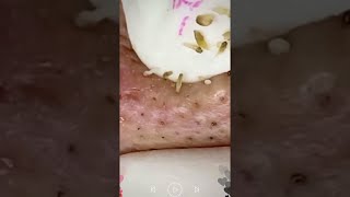 Skincare | Blackheads Removal #461 #tweezers skincare #blackheads blackheads
