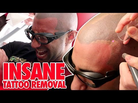 I GOT LASER TATTOO REMOVAL ON MY HEAD!