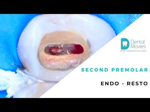 Second premolar  Endo   resto