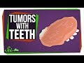 Understanding Tumors and Teratomas
