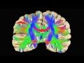 Understanding Concussions