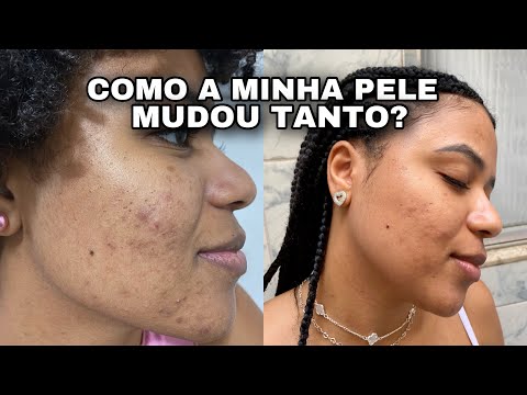 DIÁRIO DA PELE ACNEICA ✨ como a minha pele mudou? + produtos que eu tenho usado