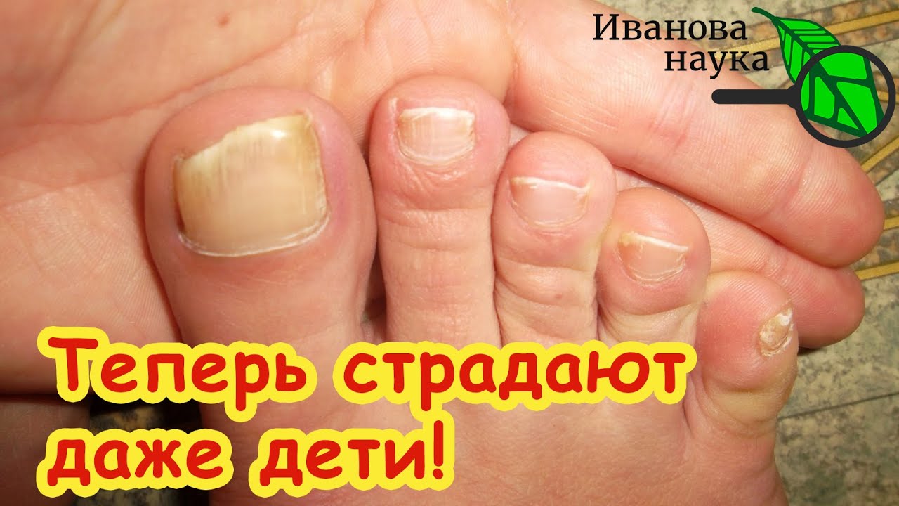 Хотите избавиться от грибка навсегда без этого вам не избавиться от него никогда!
