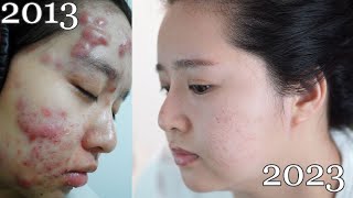 Accutane Update 10 Years Post Treatment