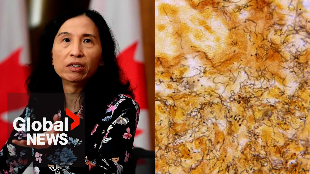 “Alarming increase” of syphilis cases in Canada: top doctor