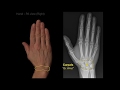 Hand X-Ray Views and Anatomy
