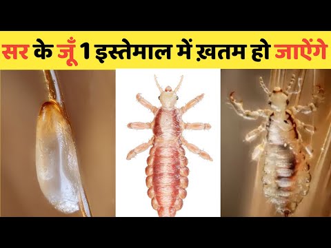 Head Lice & Nits Removal at home | सिर की लिखें और जुएं 1 ही बार में ख़तम करने का घरेलु उपाय