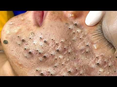 BigCysticAcneBlackheadsExtractionBlackheadsMilia,WhiteheadsR