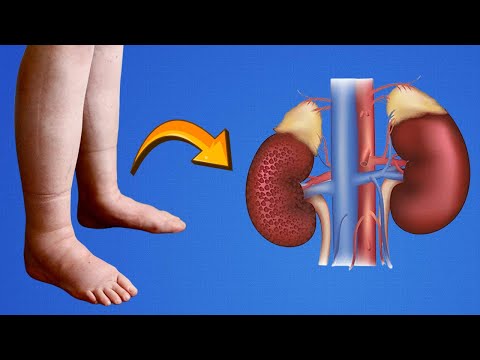 What Are Signs that Stage 3 Kidney Disease is Getting Worse?