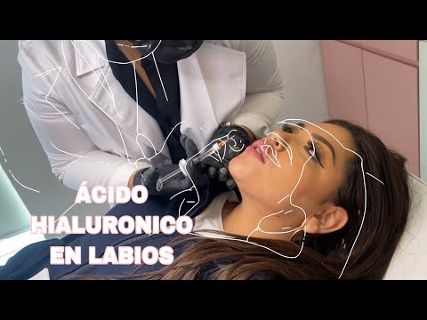 MI EXPERIENCIA CON | LABIOS INYECTADOS