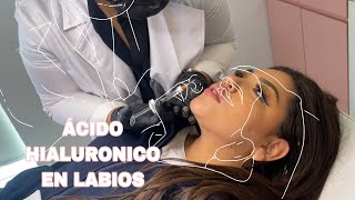 MI EXPERIENCIA CON | LABIOS INYECTADOS