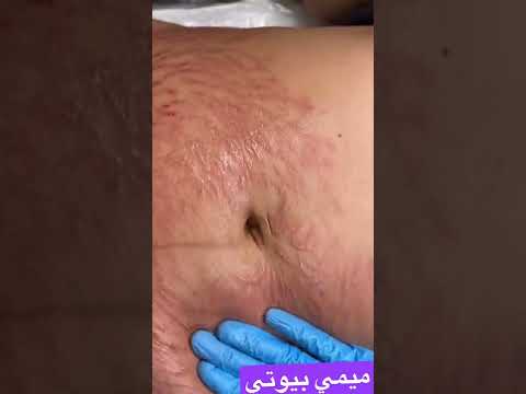 مين ناطر تحدي ازالة التشققات من البطن والدهون الحشوية استنوني بكرًا مساءً بتوقيت المانيا الساعة 7♥️