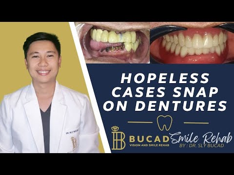 Hopeless Cases Snap on Dentures. Best Dental Optical Clinic Manila Philippines