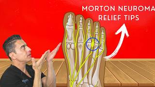 Relieve Morton’s Neuroma Pain: Best Tips and Tricks