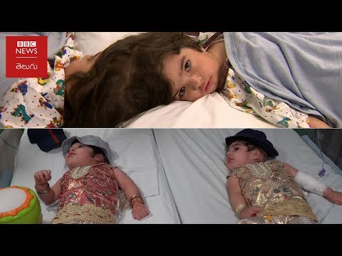 తలలు అతుక్కొని పుట్టారు.. వైద్యులు ఇలా విడదీశారు