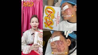 💖បងៗណាខ្លះមានបញ្ហាស្បែកមុខកើតមុន មុនខ្ទុះ មុនដំបូងធំៗ មុនកប់សាច់ មុនក្បាលខ្មៅ