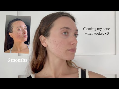 How I'm clearing my acne! What is working - health routine, microneedling, & feeling confident