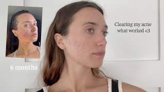 How I'm clearing my acne! What is working - health routine, microneedling, & feeling confident