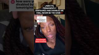 This Drug Rash Can Turn Deadly: The Warning Sign Everyone Misses (SJS)