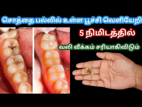 5 நிமிடத்தில் சொத்தைப் பல்லில் உள்ள பூச்சி வெளியேறி வழி சரியாகிவிடும் /sothai pal sariyaga cavity