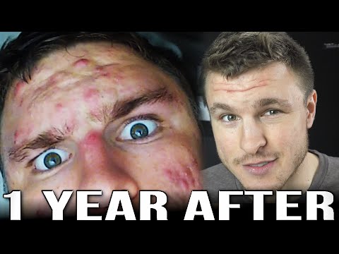 1 Year After Accutane & Plans For Acne Scars (Laser Surgery)