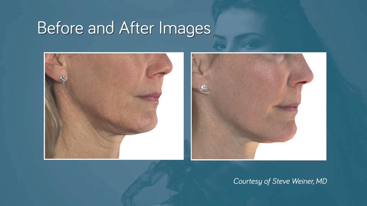 Before and after cosmetic treatment comparison image.