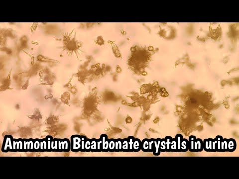 Ammonium Bicarbonate crystals in urine microscopy