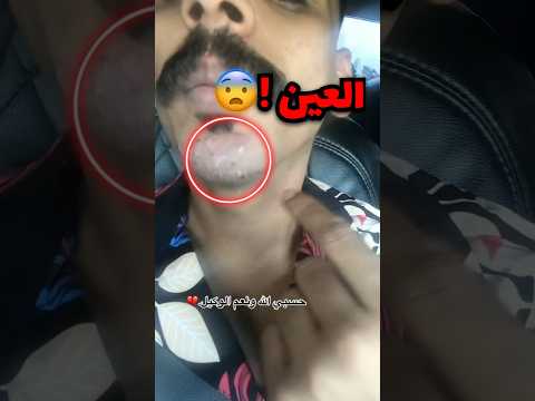 عطوه عين وهذا اللي صار فيه!! (صدمة)