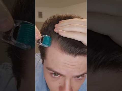 How to Microneedle with Minoxidil for Quickest Hair Results (Linked in Bio)