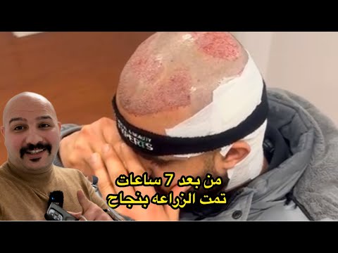 زراعة الشعر في المانيا و اوروبا | نور و سنان|