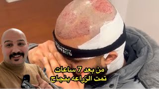 زراعة الشعر في المانيا و اوروبا | نور و سنان|