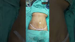 Tummy Tuck Surgery