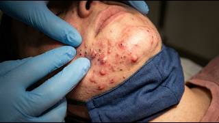 Loan Nguyen Acne Treatment 17jj