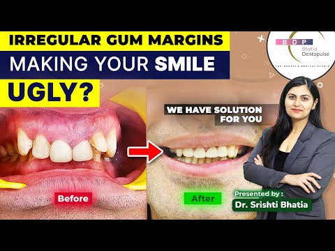 Smile Makeover for IRREGULAR Gum Margins that are making your smile UGLY #smilemakeover #smile