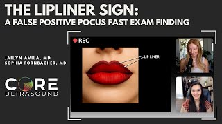 Exploring the Lip Liner Sign: Avoiding False Positives in FAST Examinations