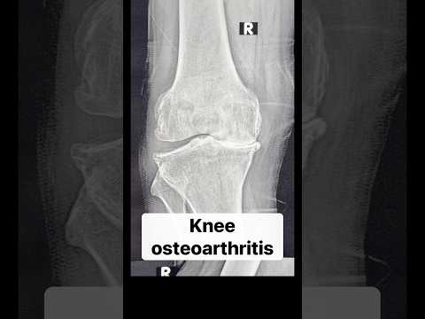 Do both knees need Replacement together? -what happens if we replace one knee #totalkneereplacement
