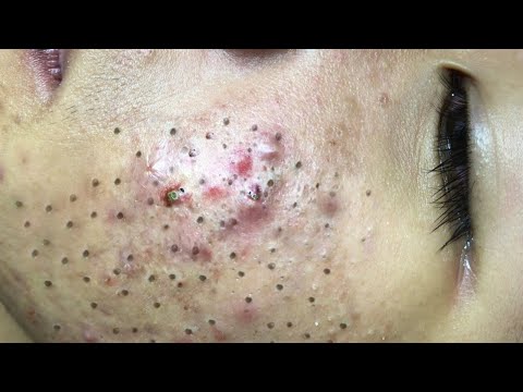 Blackhead Removal With Sac Dep Spa @100074099