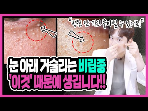 "절대 짜지마세요!" 눈밑 비립종! 대체 왜 있어? 집에서 비립종을 없애는 홈케어 방법