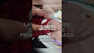 Las infecciones cutáneas se propagan en Gaza