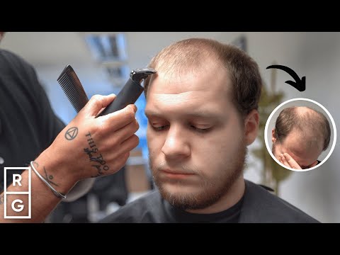 He Hid THINNING Hair for YEARS! “I Can Go Outside WITHOUT a Hat NOW!” | Talking Hair Loss